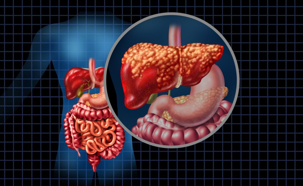 Ilustração médica detalhando um fígado com acúmulo de gordura no fígado (esteatose hepática) em comparação ao sistema digestivo.