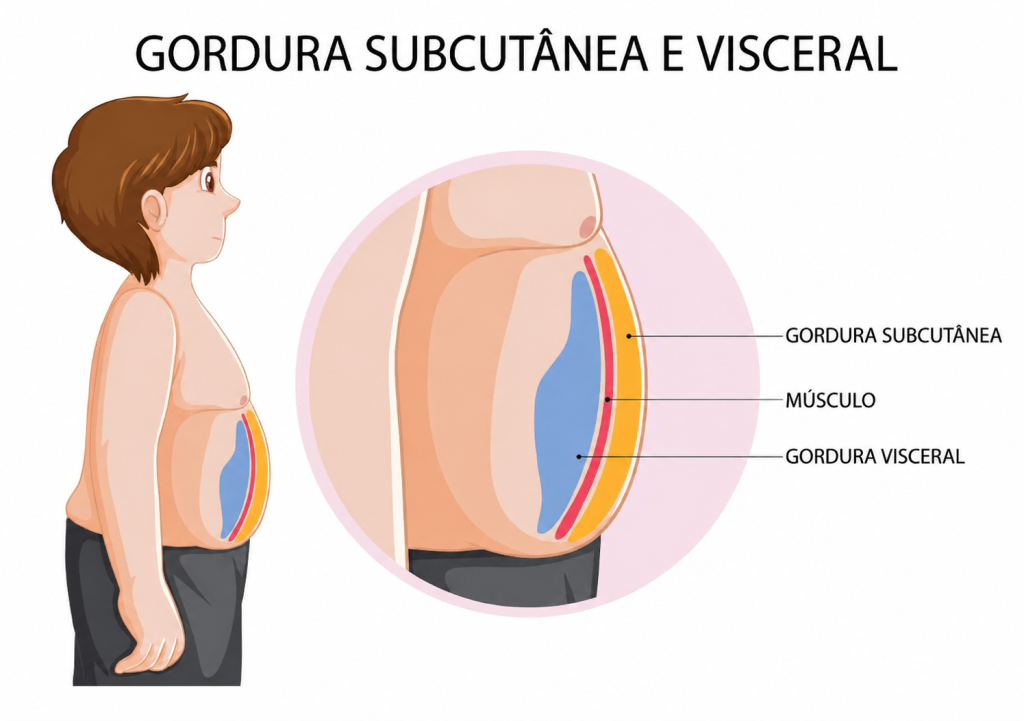 nfográfico comparando gordura subcutânea (externa) e gordura visceral (interna e entre órgãos) no corpo humano.