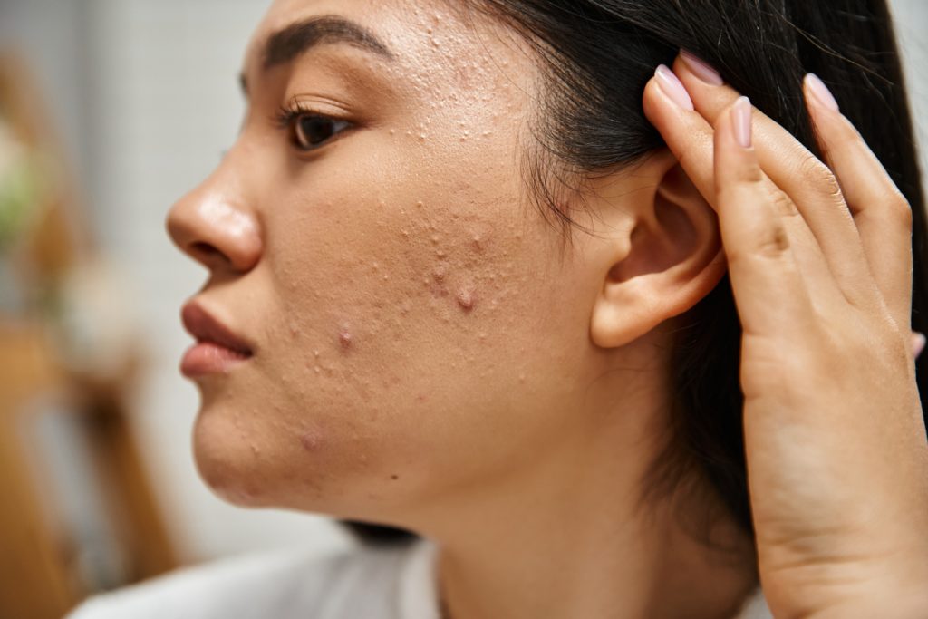 Close do rosto de uma mulher com acne na bochecha, evidenciando um dos sintomas hormonais que impactam a saúde da mulher com SOMP.