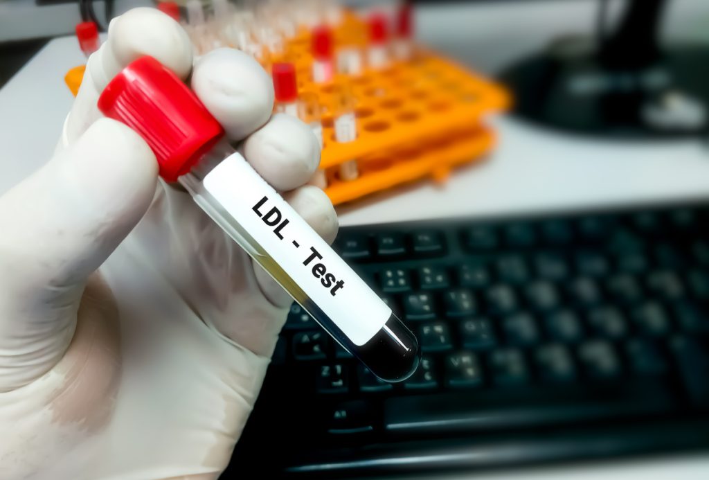 Mão com luva médica branca segurando um tubo de ensaio com sangue contendo o rótulo "LDL - Test", utilizado para medir os níveis de colesterol e diagnosticar a dislipidemia.