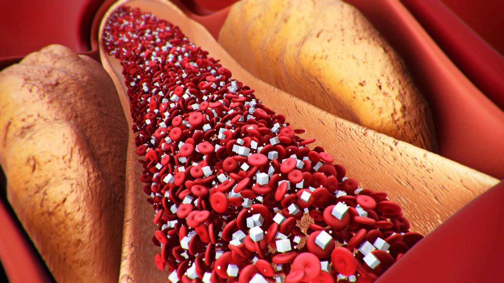 Ilustração 3D do interior de uma artéria com acúmulo de gordura e células sanguíneas, associando às complicações vasculares do diabetes tipo 2